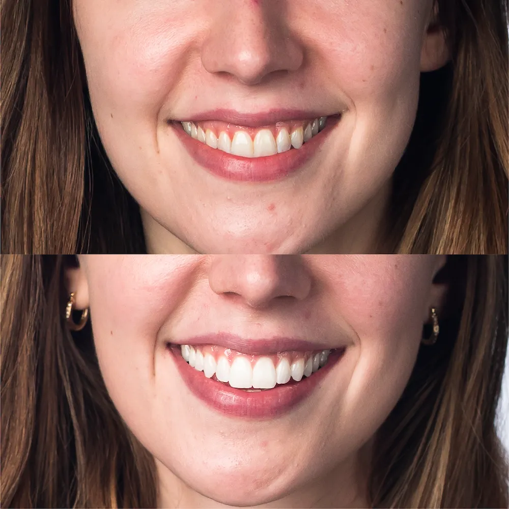 GET BRITE™ Teeth Whitening Pen